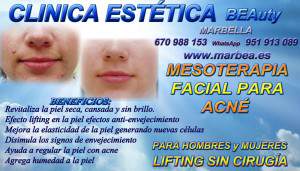 Marbella - La Mesoterapia Facial y corporal  corrige la falta de ACN Y MARCAS DE ACNÉ 