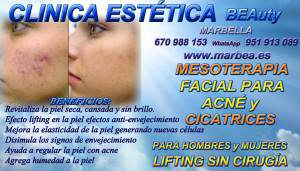 Marbella - La Mesoterapia Facial y corporal  corrige la falta de ACN Y MARCAS DE ACNÉ 