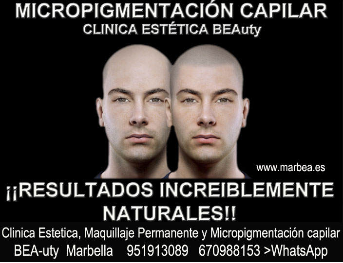 micropigmentación capilar Valencia Clínica Estética y tratamiento contra la alopecia Marbella: Te ofrecemos la mayor calidad de nuestroservicio micropigmentación capilar Valencia 